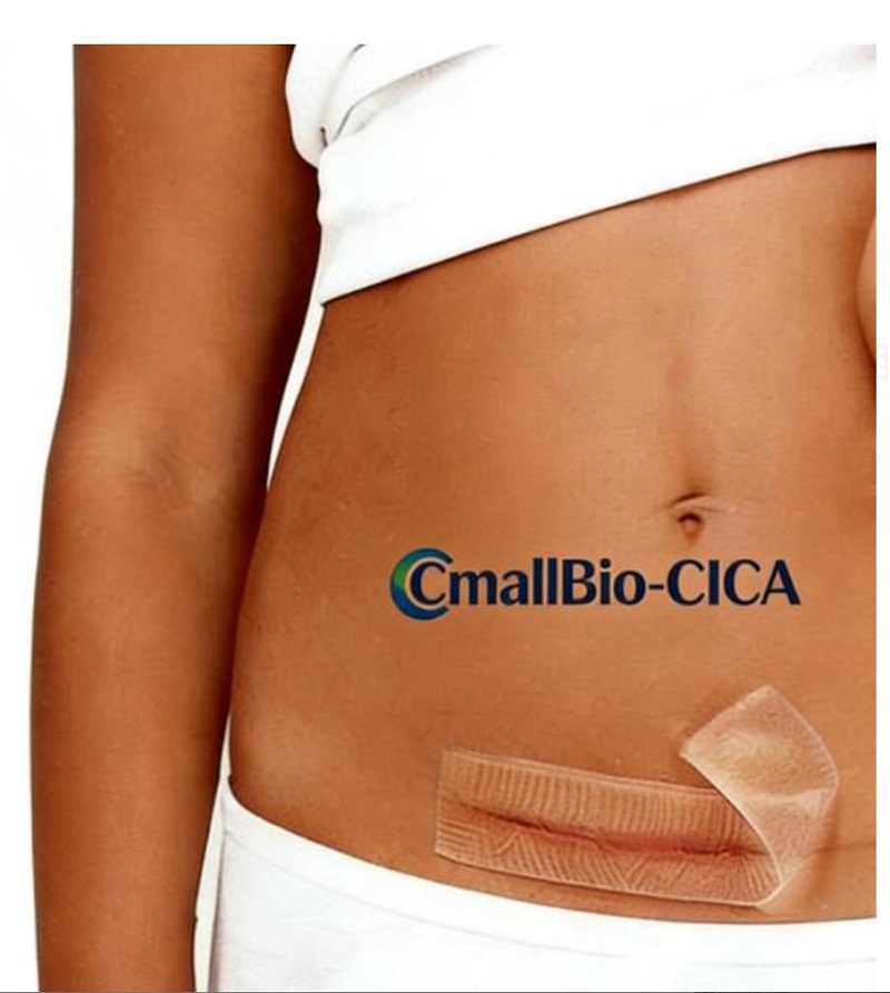 Qual adesivo de cicatriz é melhor para cicatrizes hipertróficas de cesariana? Um guia de compra de adesivos para cicatrizes de nível médico 2026 Qual adesivo de cicatriz é melhor para cicatrizes hipertróficas de cesariana? Um guia de compra de adesivos para cicatrizes de nível médico 2026